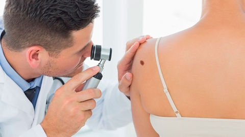 Nốt ruồi, vết bớt và nốt sắc tố dưới góc nhìn y khoa: Khi nào cần cảnh giác?