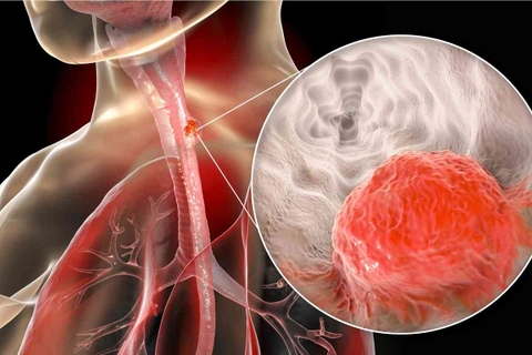 Nuốt nghẹn, đau ngực, sụt cân nhanh – Dấu hiệu cảnh báo ung thư thực quản