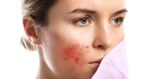 Viêm lỗ chân lông: Nguyên nhân, dấu hiệu và cách điều trị hiệu quả tại nhà