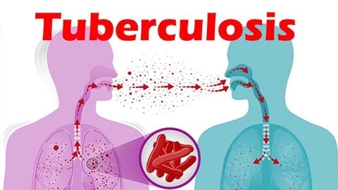 Bệnh Lao: Nguyên Nhân, Triệu Chứng, Cách Phòng Ngừa Và Điều Trị Hiệu Quả