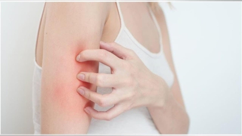 Nổi mẩn ngứa: Cơ chế sinh bệnh, chẩn đoán phân biệt và hướng điều trị theo y học hiện đại