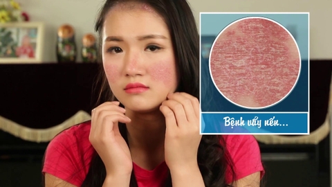 Vẩy nến là gì? Nguyên nhân, triệu chứng và hướng kiểm soát hiệu quả