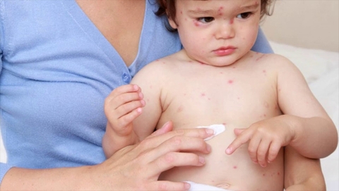 Thủy đậu là bệnh gì? Triệu chứng, cách lây và cách phòng ngừa hiệu quả