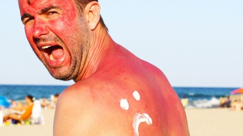 Cách xử trí nhanh khi bị bỏng da, mắt