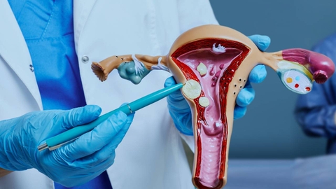 U xơ tử cung: Dấu hiệu, nguyên nhân và cách điều trị hiệu quả chị em cần biết