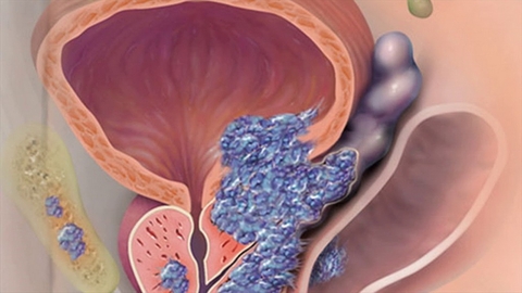 Giải pháp hỗ trợ tuyến tiền liệt và tăng cường sinh lực nam giới toàn diện