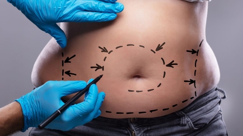 Có nên đi hút mỡ cơ thể? Sự thật cần biết trước khi quyết định can thiệp hút mỡ bụng, đùi, bắp tay, bắp chân, lưng