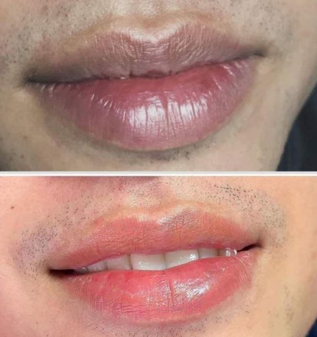 Khử thâm môi nam tại Hani Beauty lên màu tự nhiên, bền bỉ