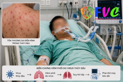 Nam bệnh nhân 32 tuổi bị biến chứng thuỷ đậu phải thở máy kéo dài