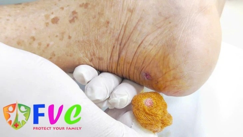 Vết thương nhỏ do gà mổ, nguy cơ lớn nếu không xử trí đúng cách