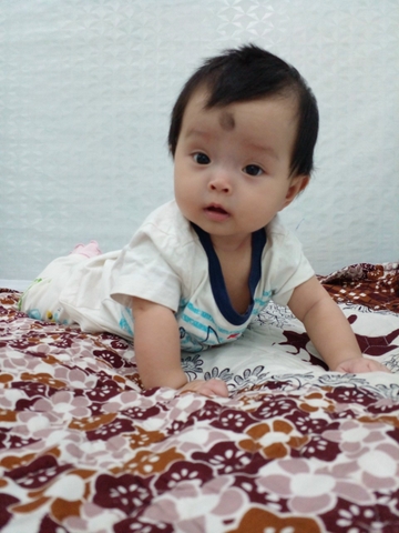 Vàng da ở trẻ sơ sinh: Cách phát hiện, phân biệt với các bệnh lý- Tắm nắng cho trẻ có thể giúp điều trị vàng da sơ sinh không?