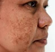 NÁM DA LÀ GÌ? LÀM THẾ NÀO ĐỂ HẾT NÁM DA?