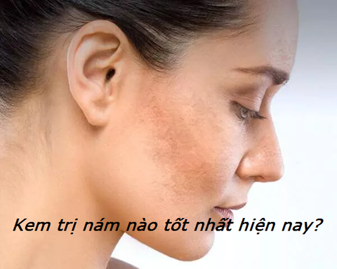 KEM TRỊ NÁM NÀO TỐT NHẤT HIỆN NAY