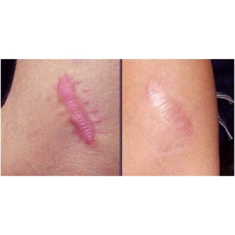 Kem làm mờ sẹo Contractubex 30g