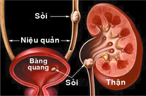 Thực phẩm nên và không cho người sỏi thận