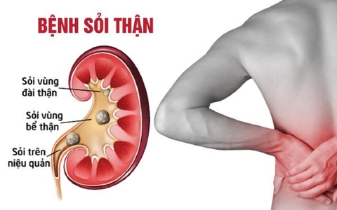 Nguyên nhân, triệu trứng và phương pháp điều trị bệnh sỏi thận