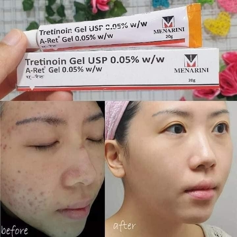 Kem Dưỡng Menarini Tretinoin 0.025%