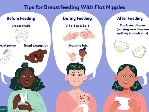 TỤT NÚM VÚ/ ĐẢO NGƯỢC NÚM VÚ