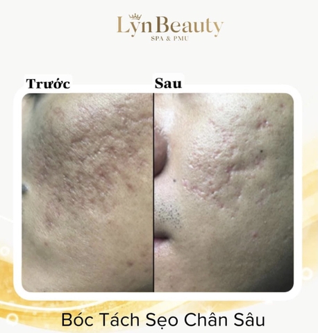 Dưỡng Chuyên Sâu  Sẹo Rỗ , Lỗ Chân lông to .