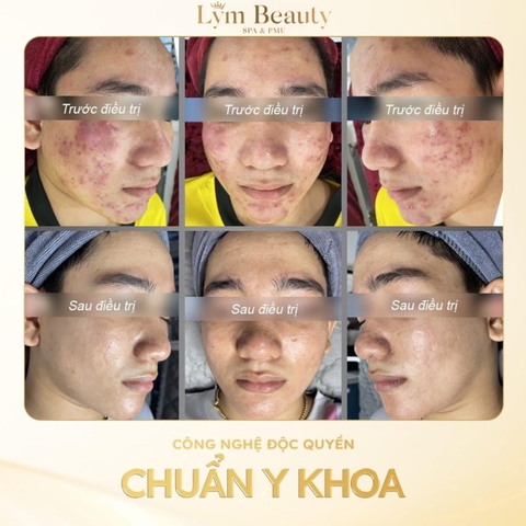 Chăm Sóc Da Mụn Chuyên Sâu