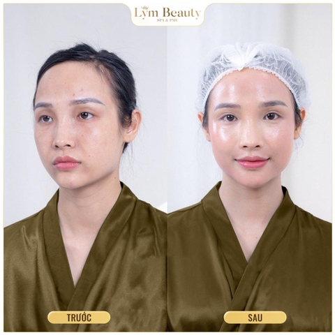 Chăm Sóc  Da Nám Chuyên Sâu