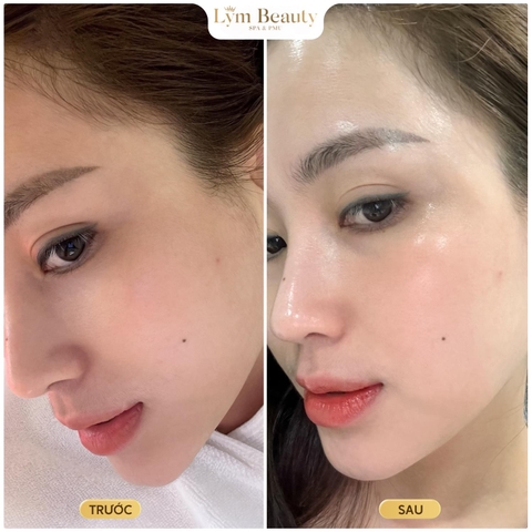 Chăm Sóc  Da Nám Chuyên Sâu