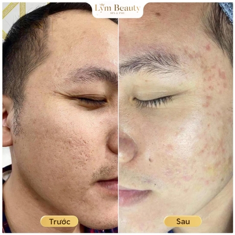 Dưỡng Chuyên Sâu  Sẹo Rỗ , Lỗ Chân lông to .