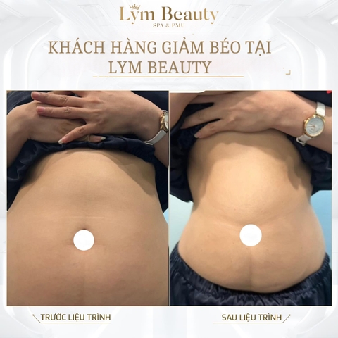 Massage Hủy Mỡ Không Xâm Lấn