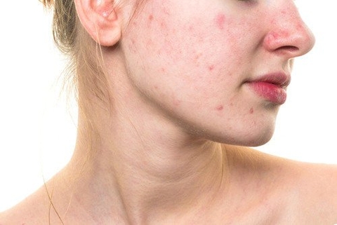 Dấu hiệu gan đang thải độc qua da