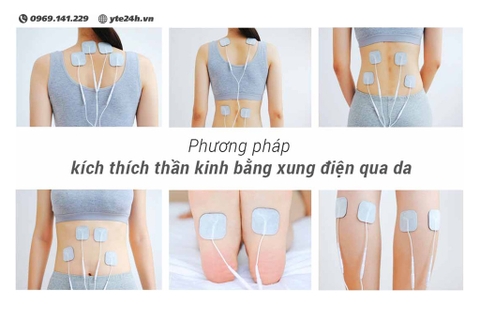 Kích thích thần kinh dưới da bằng xung điện (TENS) là gì?