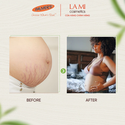 Trị rạn Palmer's Tummy Butter 125g