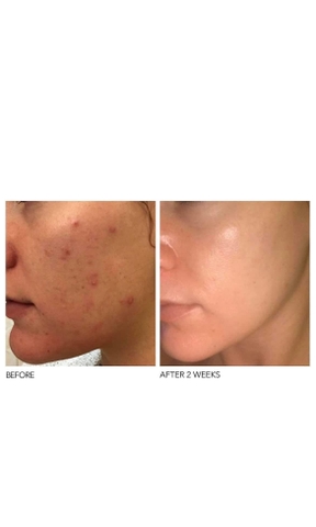 Tẩy tế bào chết Peel da sinh học Dr Dennis Gross Alpha Beta Extra Strength Daily hộp 3 miếng