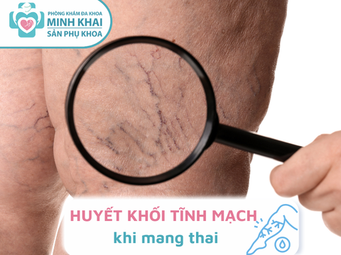 NGUYÊN NHÂN - PHÒNG NGỪA Huyết khối tĩnh mạch khi mang thai.