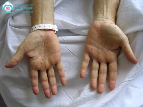 Bệnh giang mai là gì? Nguyên nhân, dấu hiệu, cách điều trị bệnh ở nam và nữ