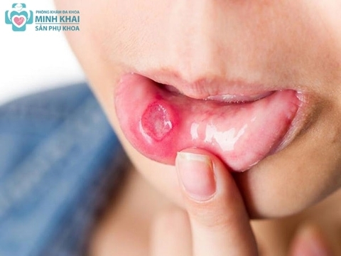 Các giai đoạn của HIV và biểu hiện qua từng giai đoạn