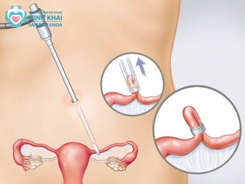 Những Cách Tránh Thai Khi Quan Hệ Không An Toàn