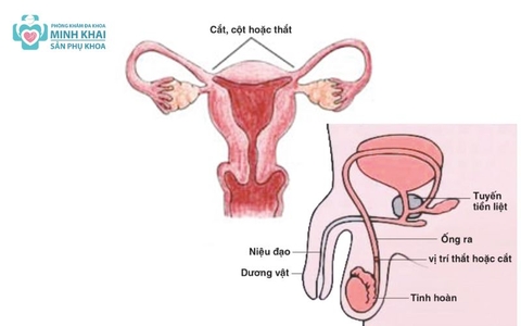 Cách Tránh Thai Sau Khi Quan Hệ Không Cần Thuốc