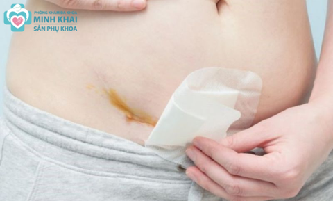 Hướng Dẫn Chi Tiết Cách Vệ Sinh Vết Mổ Sau Sinh Cho Các Mẹ
