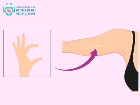 Cấy Que Tránh Thai Có An Toàn Không, Nên Thực Hiện Không?