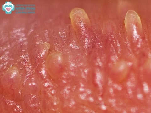 Gai sinh dục là gì? Nguyên nhân dấu hiệu, cách chữa bệnh ở nam và nữ