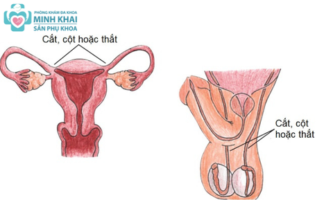 Ưu Nhược Điểm Của Biện Pháp Tránh Thai Vĩnh Viễn