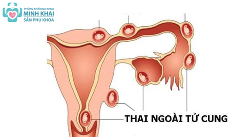 Thai Ngoài Tử Cung Nguy Hiểm Không? Nguyên Nhân, Dấu Hiệu Thai Ngoài Tử Cung