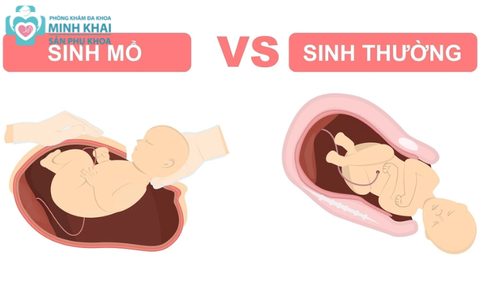 Nên Sinh Thường Hay Sinh Mổ? Ưu Nhược Điểm Của Từng Phương Pháp Sinh