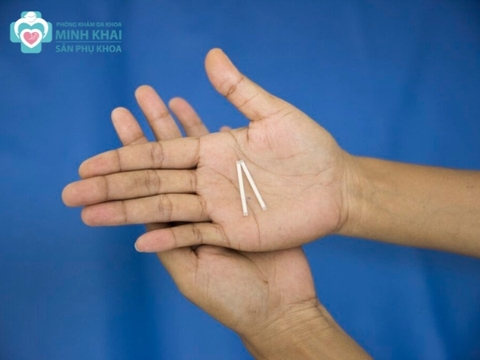 Những Điều Cần Biết Về Que Cấy Tránh Thai Jadelle