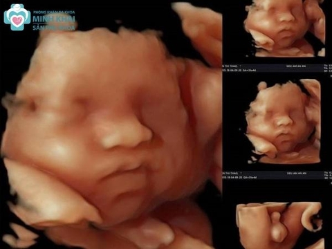 Siêu  Âm 3D Trong Sản Khoa Có Đặc Điểm Gì Nổi Bật?