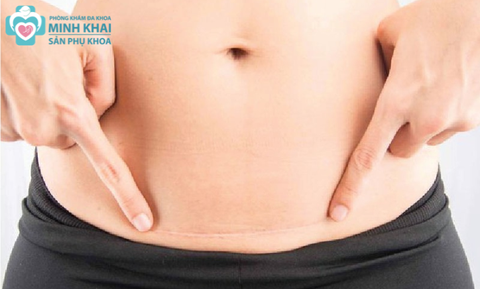 Sinh Mổ Lần 4 Có Được Không? Sinh Mổ Lần 4 Tiềm Ẩn Những Rủi Ro Gì Cho Mẹ Và Bé