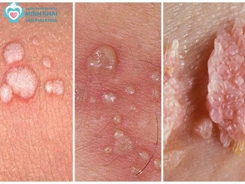 Bệnh sùi mào gà là gì? Dấu hiệu, cách trị và cách phòng tránh bệnh