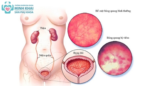 Viêm Đường Tiết Niệu Nữ: Nguyên Nhân, Dấu Hiệu Và Cách Điều Trị Hiệu Quả