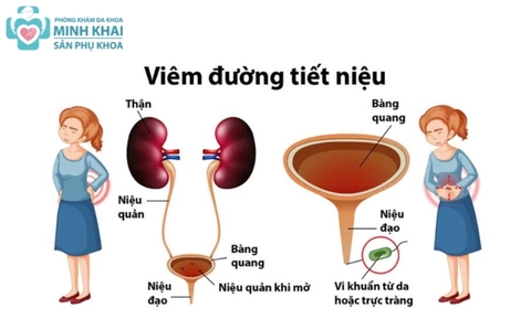 Dấu Hiệu Viêm Đường Tiết Niệu Và Cách Điều Trị Hiệu Quả