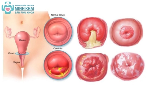 Viêm Lộ Tuyến Cổ Tử Cung Độ 2 Nguy Hiểm Không? Có Tự Khỏi Không?
